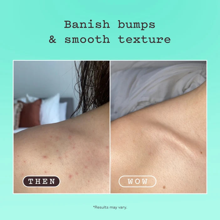 Before-and-after comparison showing skin texture and bumpy redness on a person's shoulder and upper back, with text reading 'Banish bumps & smooth texture' on a mint background.