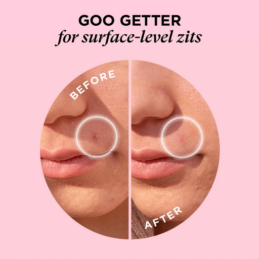 Before and after comparison of a zit on skin with  ZITSTICKA 'Goo Getter' text.