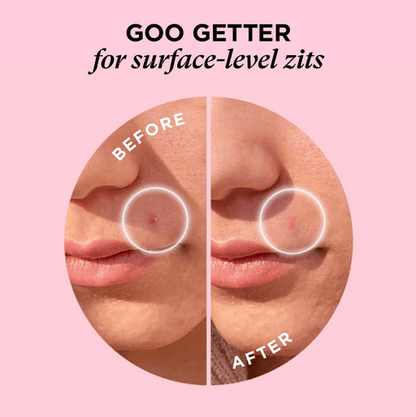 Before and after comparison of a zit on skin with  ZITSTICKA 'Goo Getter' text.