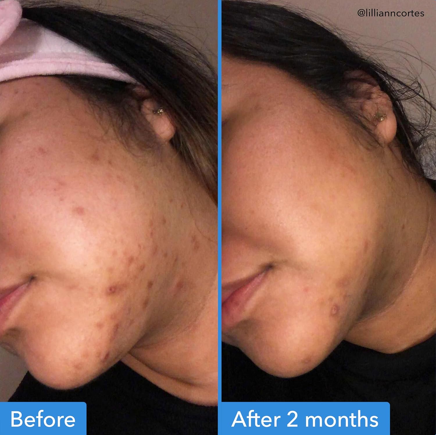 Before and after comparison of a person's face with acne, showing improvement over 2 months Good Molecules .