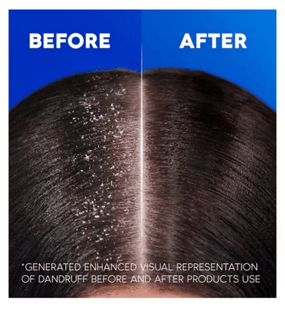 Before and after results showing effectiveness of Head & Shoulders Classic Clean 2in1 Anti Dandruff Shampoo 250ml.