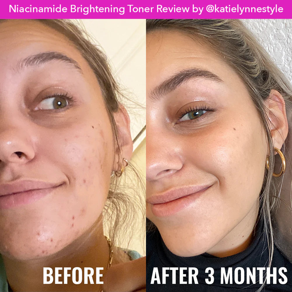 Before and after comparison of a woman's face with niacinamide brightening toner, showing visible skin improvement.