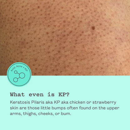 Close-up of skin with Keratosis Pilaris and text explaining the condition.