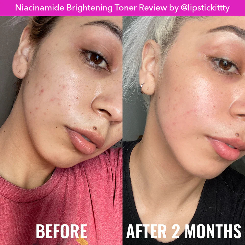 Before and after comparison of a woman's face with visible skin improvement after using Niacinamide Brightening Toner.