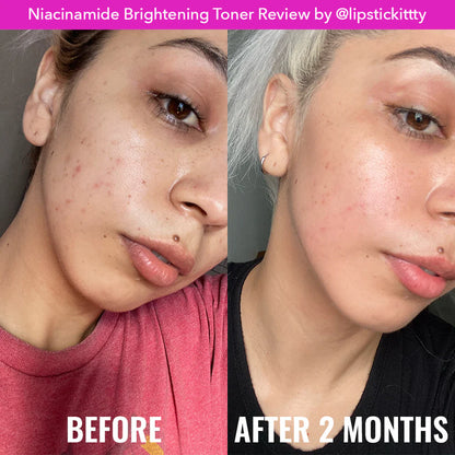 Before and after comparison of a woman's face with visible skin improvement after using Niacinamide Brightening Toner.