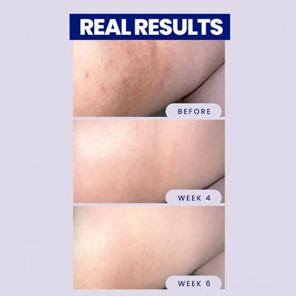 Megababe Before and after skin treatment results showing improvement over time.