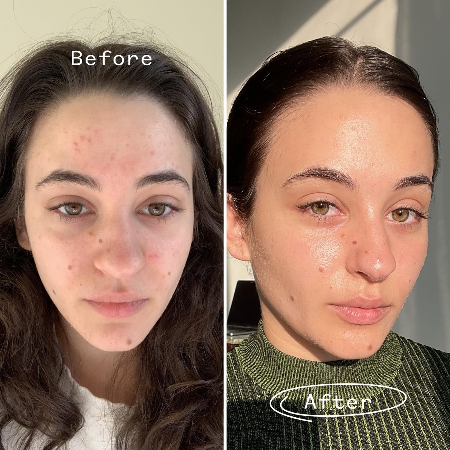 Before and after comparison of a person with acne on their face. Pai