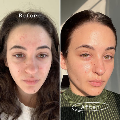 Before and after comparison of a person with acne on their face. Pai