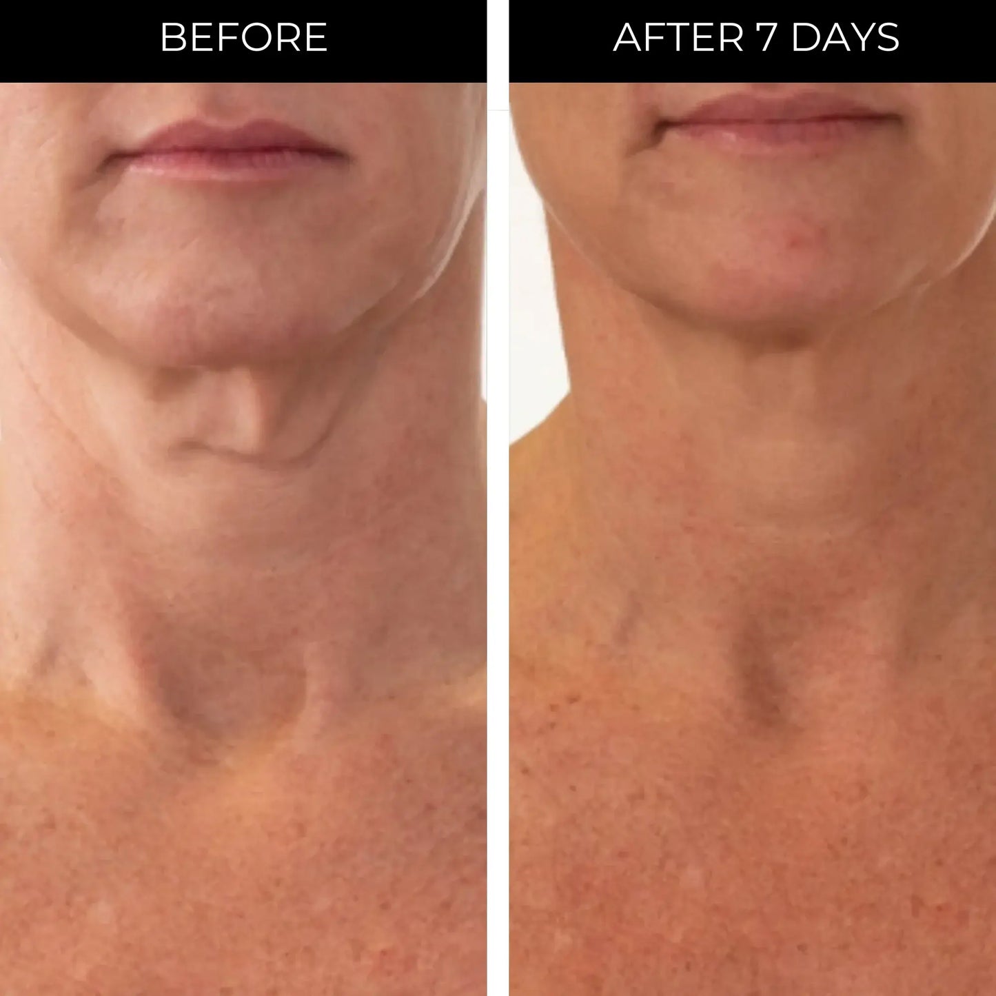 Before and after comparison of neck skin texture with text labels 'Before' and 'After 7 Days' with PRAI .