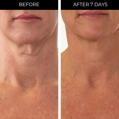 Before and after comparison of neck skin texture with text labels 'Before' and 'After 7 Days' with PRAI .