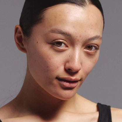 Model with blemish-prone skin showcasing the benefits of The Inkey List Targeted Blemish Duo for clear skin.