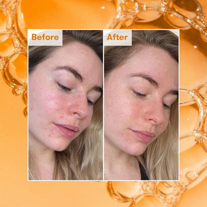 Before and after comparison of a woman's face with Ren skincare product application on an orange background.