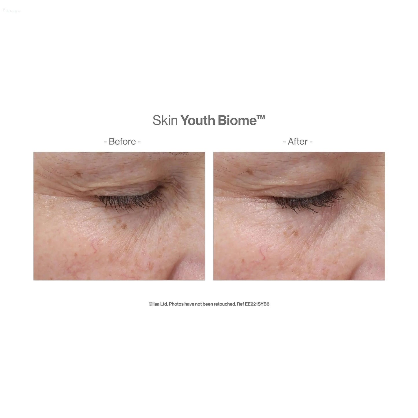Before and after results showing skin improvement with Advanced Nutrition Skin Youth Biome™ capsules.
