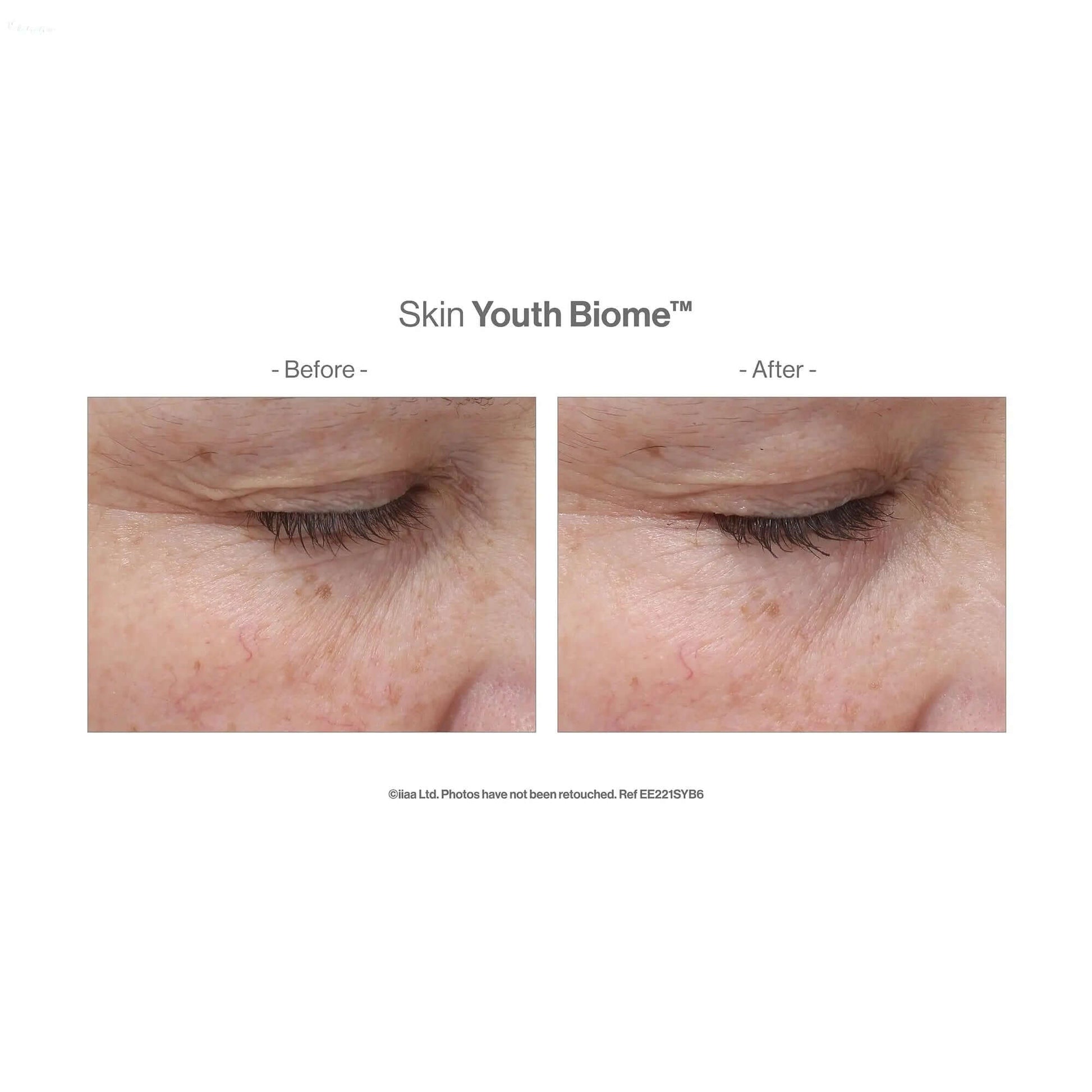 Before and after results showing skin improvement with Advanced Nutrition Skin Youth Biome™ capsules.