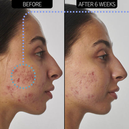 Before and after photo showing skin improvement after using The INKEY List SuperSolutions 1% Retinol Serum for 6 weeks.