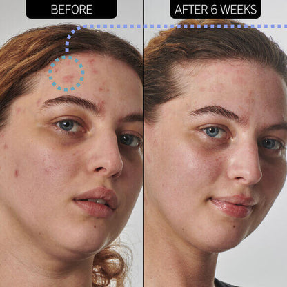 Before and after comparison of a person's face with acne treatment showing clearer skin.