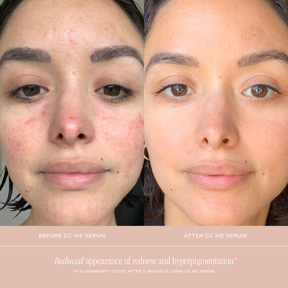 Before and after results of Summer Fridays CC Me Serum showing reduced redness and hyperpigmentation.