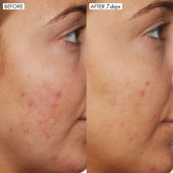 Before and after comparison of skin improvement using Sunday Riley B3 Nice 10% Niacinamide Serum over 7 days.
