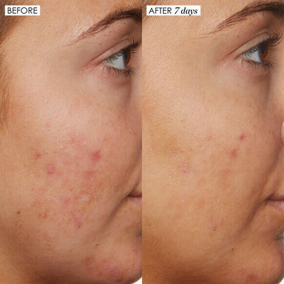 Before and after comparison of skin improvement using Sunday Riley B3 Nice 10% Niacinamide Serum over 7 days.