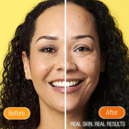 Before and after comparison of a woman's face with Superfacialist  text 'Real Skin, Real Results' on a yellow background.