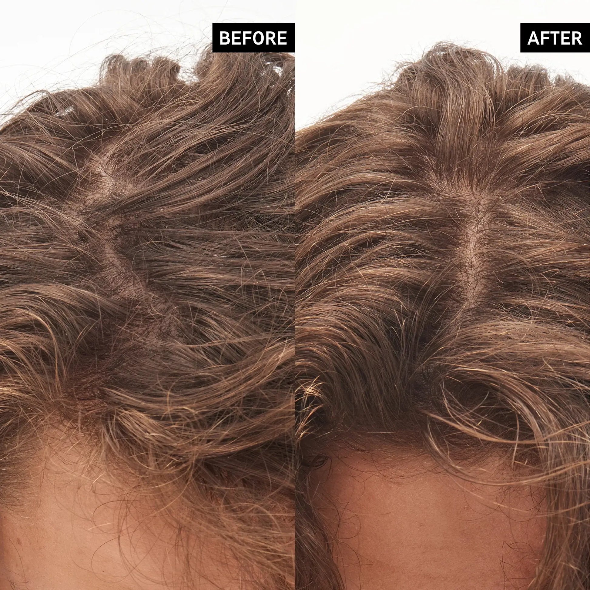 Before and after images showing scalp improvement using The INKEY List Glycolic Acid Exfoliating Scalp Scrub.