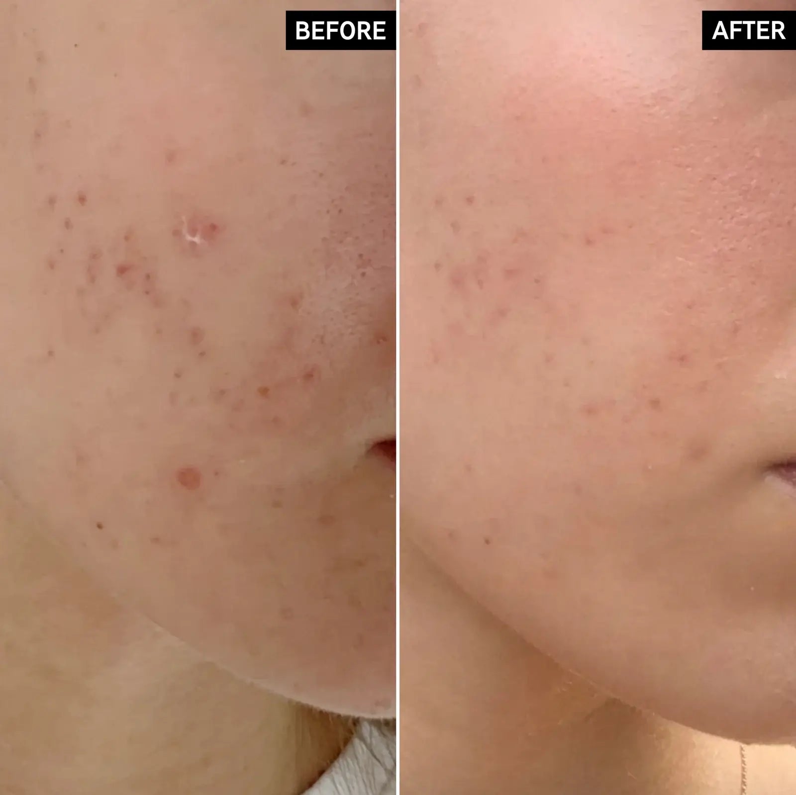Before and after results showcasing skin improvement with The INKEY List Mandelic Acid Treatment.
