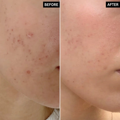 Before and after results showcasing skin improvement with The INKEY List Mandelic Acid Treatment.