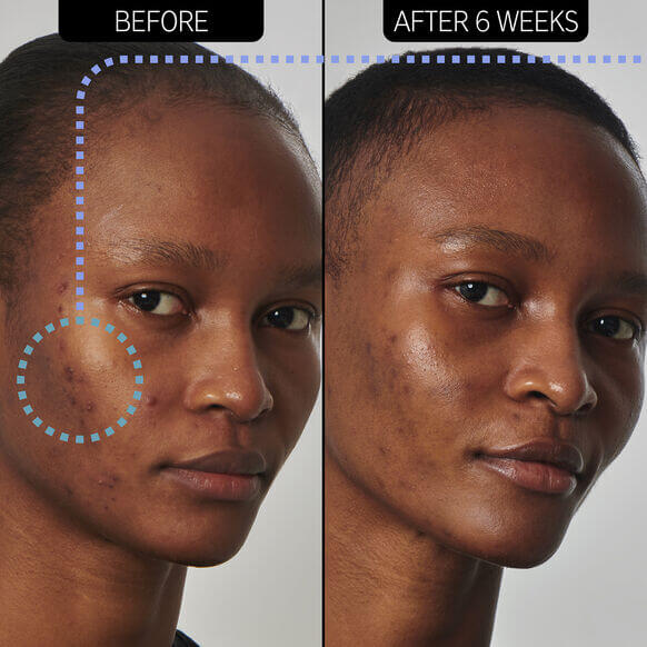 Before and after results of using The INKEY List 20% Niacinamide Serum on skin, showing improved texture and clarity.