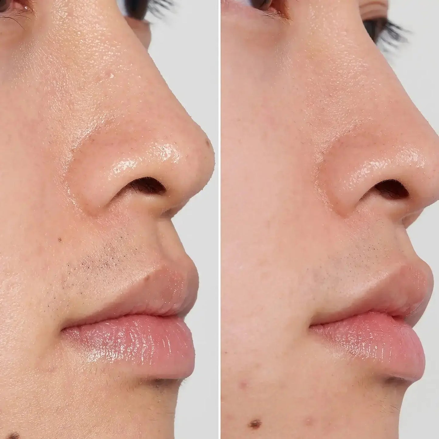 Before and after skin treatment results demonstrating clearer, smoother skin on both sides of the face.