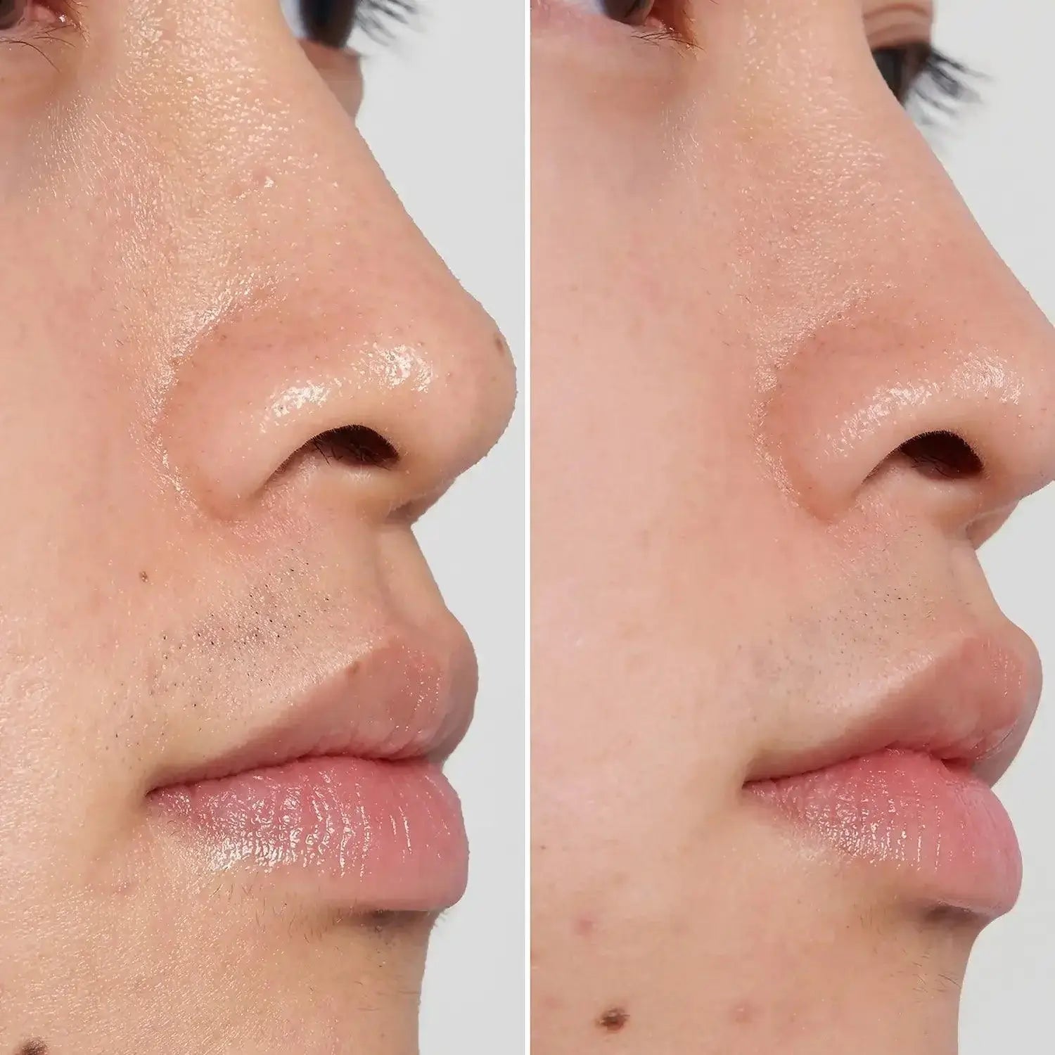 Before and after skin treatment results demonstrating clearer, smoother skin on both sides of the face.