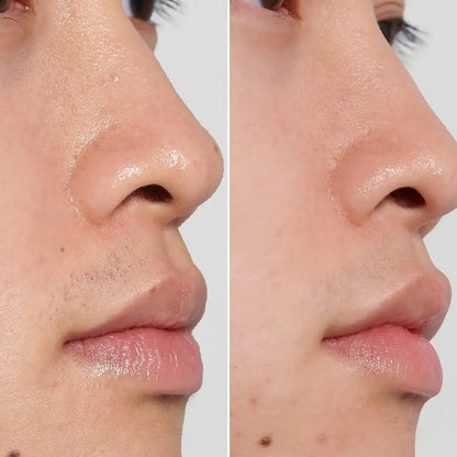 Before and after skin treatment results demonstrating clearer, smoother skin on both sides of the face.