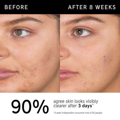 Before and after results showing clearer skin after using The INKEY List Salicylic Acid Cleanser for 8 weeks.