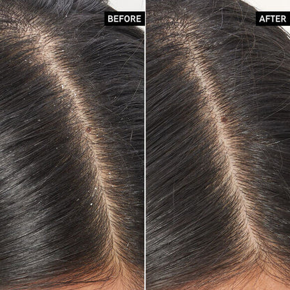 Before and after results of The INKEY List  scalp exfoliation showing improved scalp health and reduced buildup.