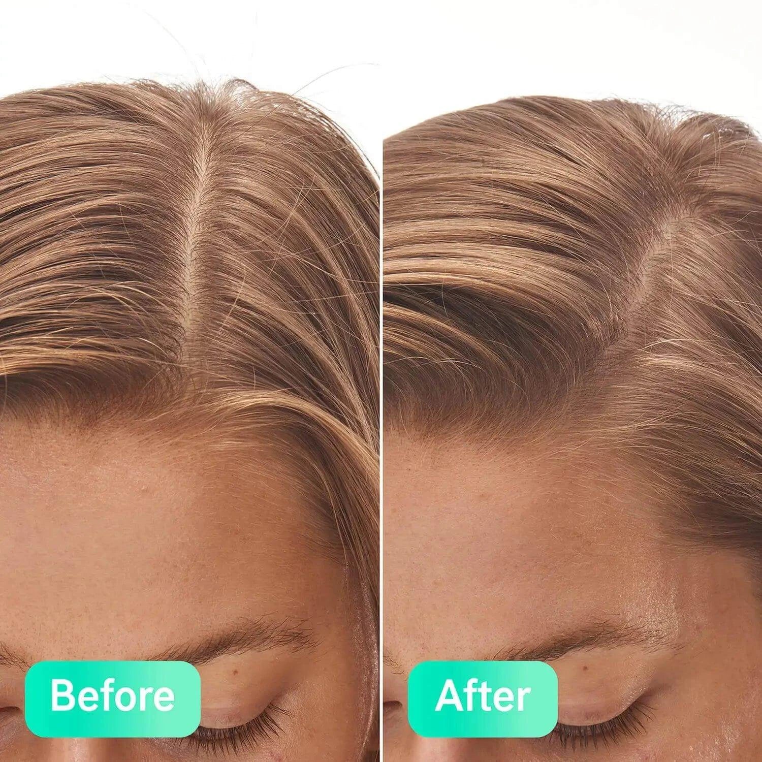 Before and after results of The INKEY List Salicylic Acid Exfoliating Scalp Treatment on hair.