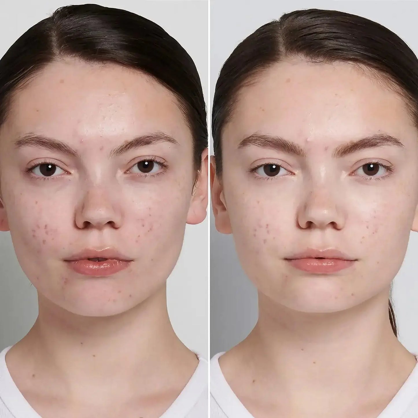 Before and after results of using The Inkey List Succinic Acid Treatment for clearer skin.