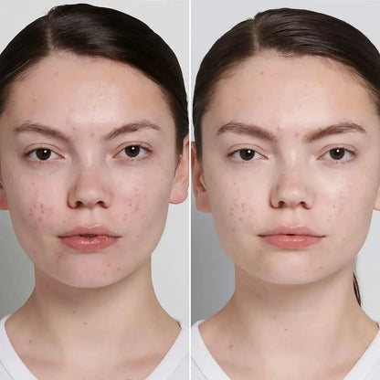 Before and after results of using The Inkey List Succinic Acid Treatment for clearer skin.