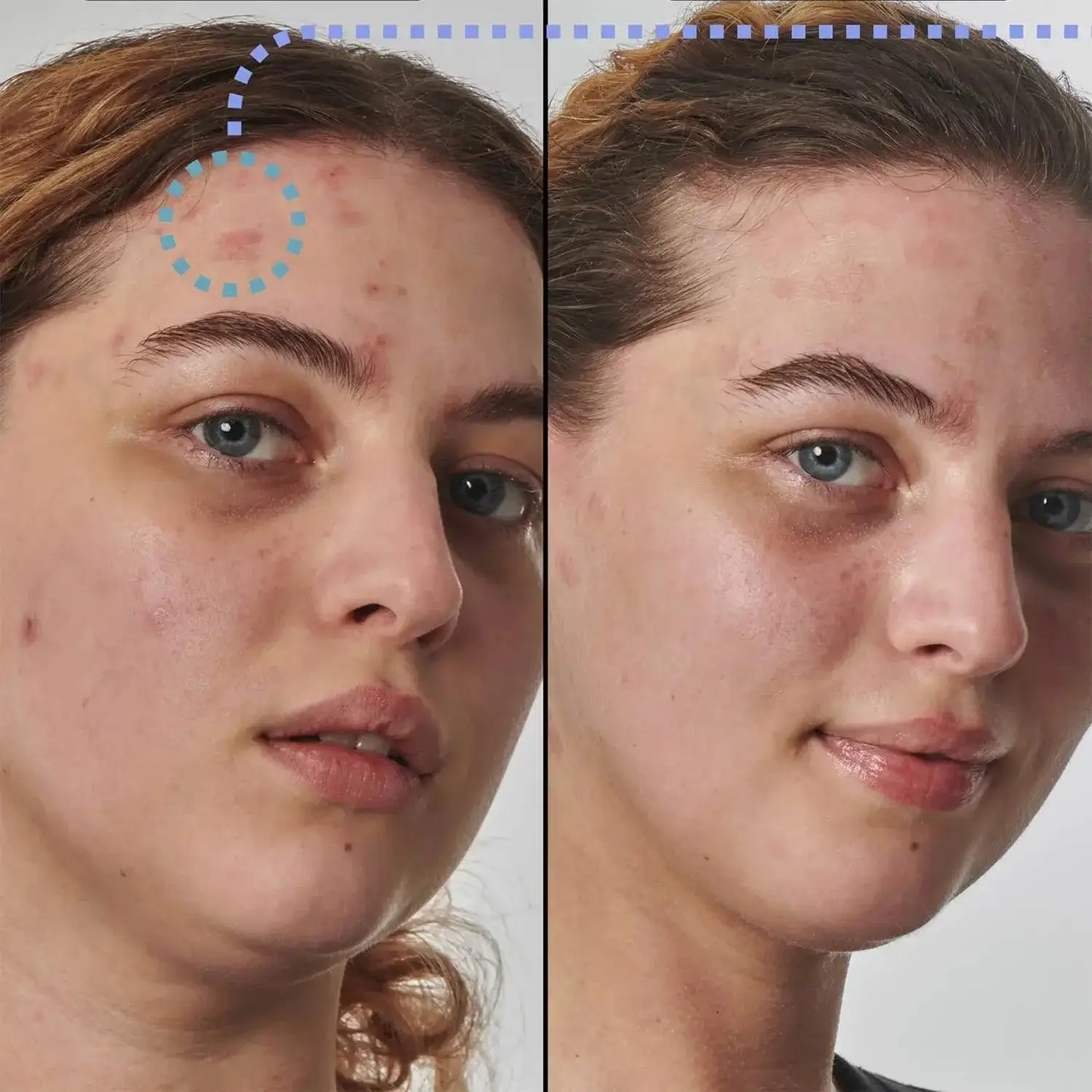 Before and after skincare treatment showing improved complexion and reduced blemishes on a woman's face.