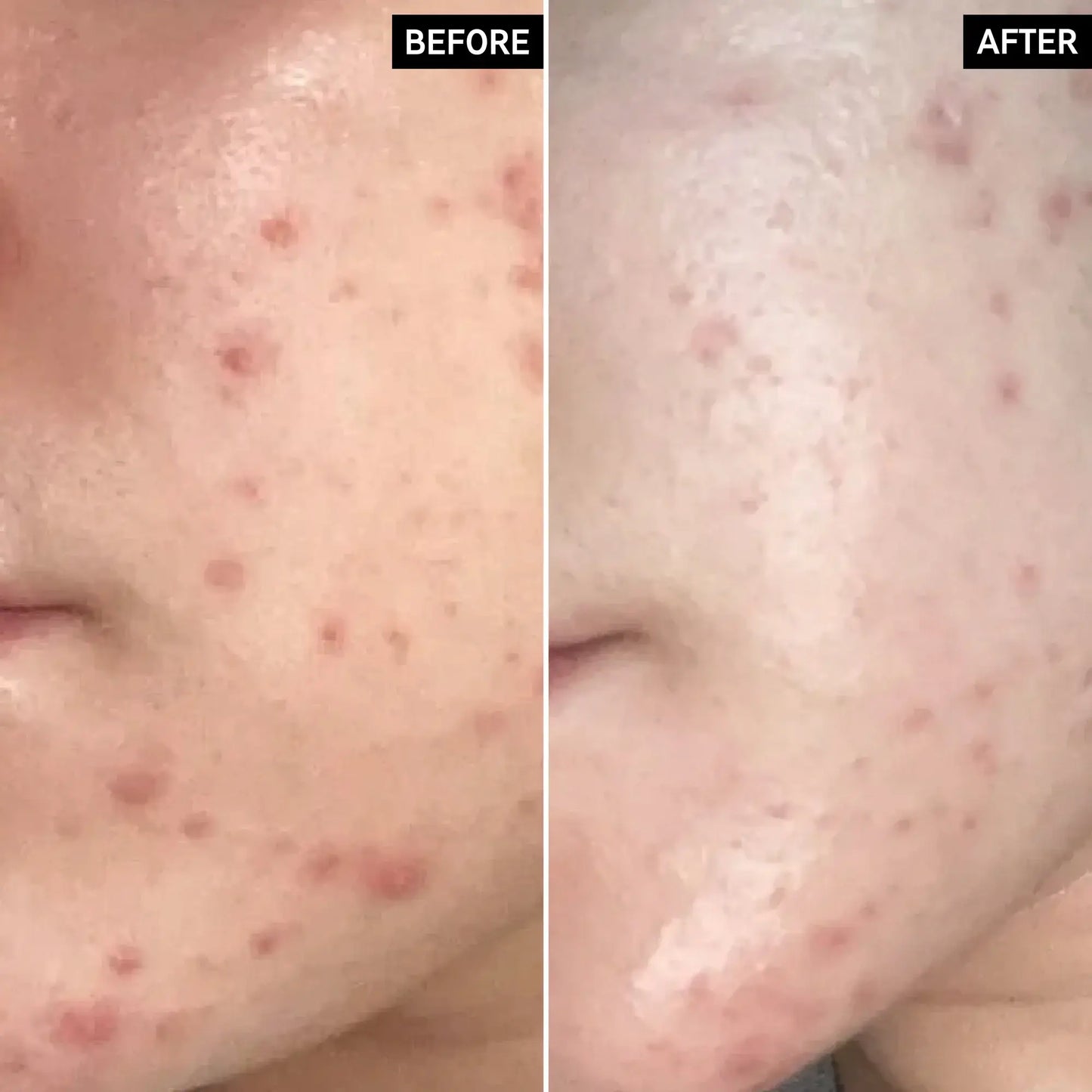 Before and after transformation of blemish-prone skin using The INKEY List SuperSolutions moisturizer.