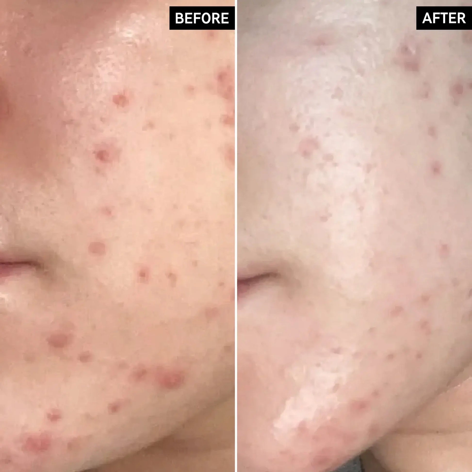 Before and after transformation of blemish-prone skin using The INKEY List SuperSolutions moisturizer.