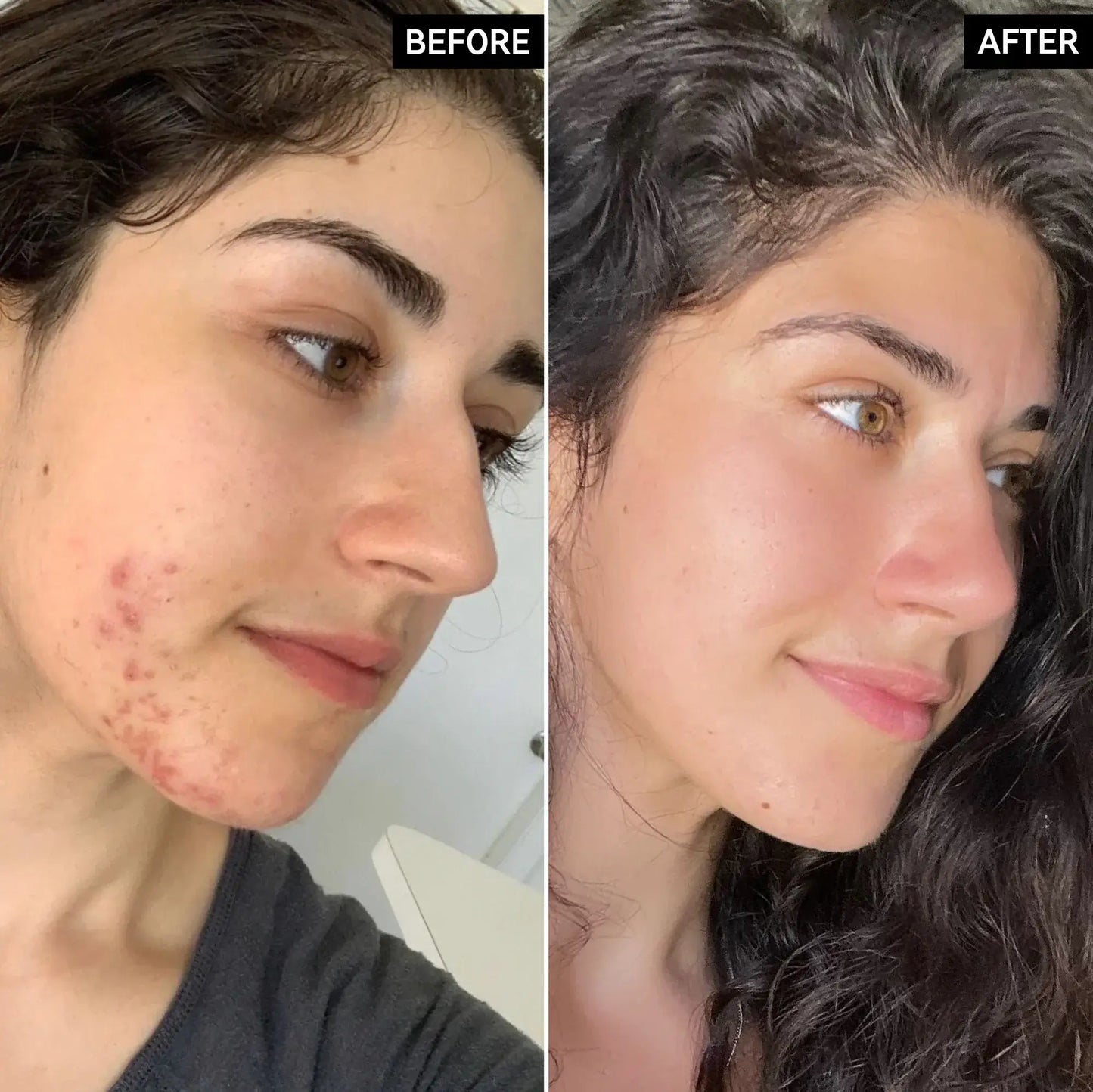 Before and after showing skin transformation using The Inkey List Targeted Blemish Duo for clearer skin.