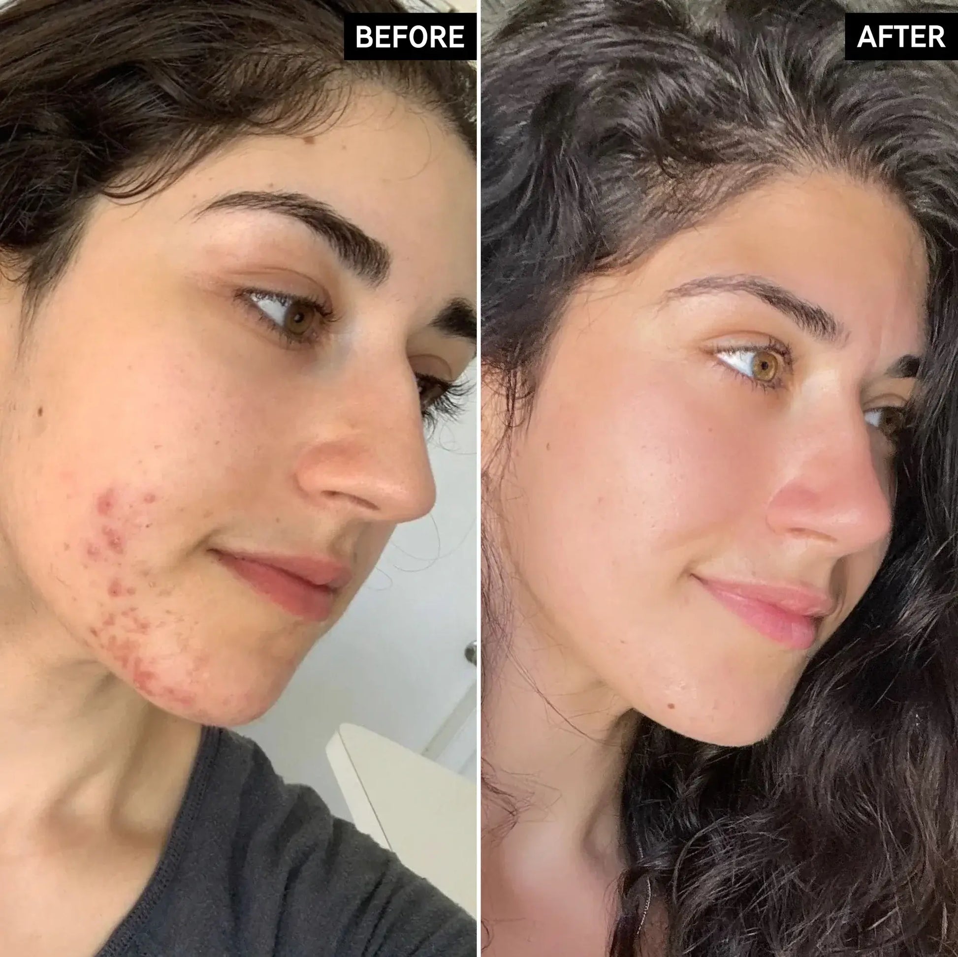 Before and after showing skin transformation using The Inkey List Targeted Blemish Duo for clearer skin.