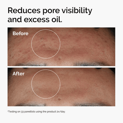 Before and after comparison showing reduced pore visibility and excess oil using The Ordinary Niacinamide 10% + Zinc 1%.