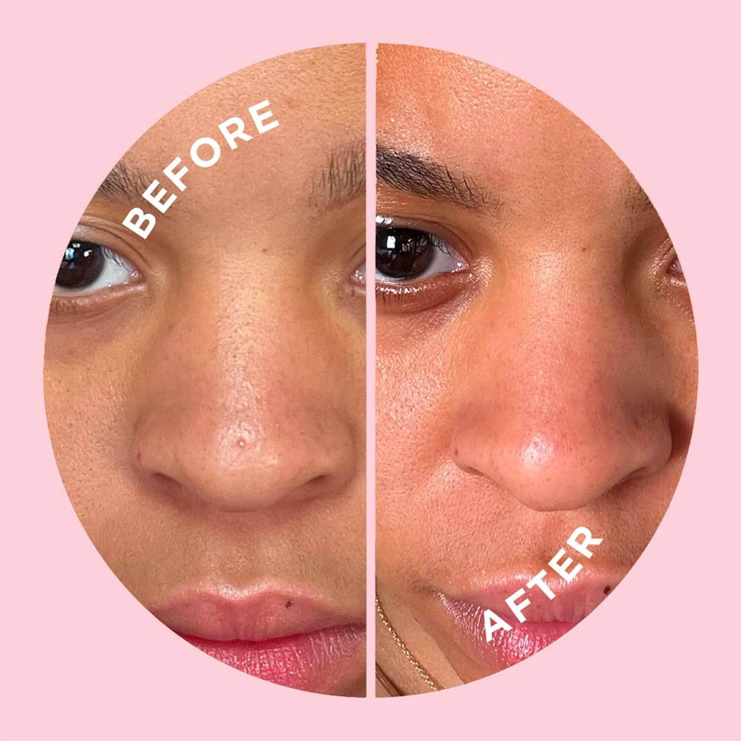 Before and after comparison of a person's face using ZITSTICKA on a pink background