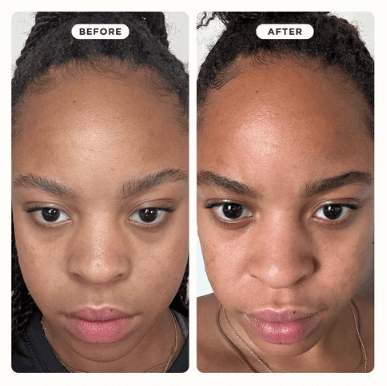Before and after results of using ZITSTICKA GOO GETTER™ Nose strips for clearer skin.