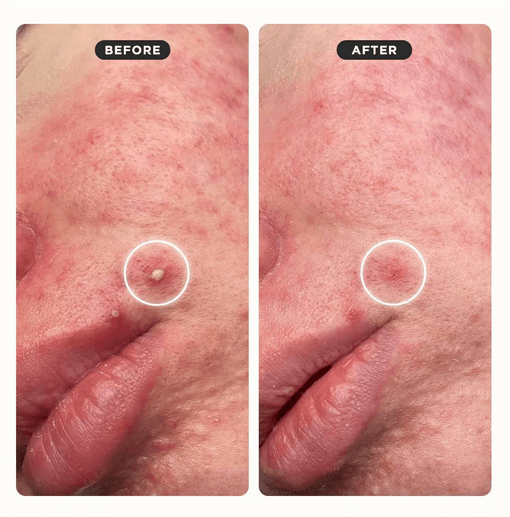 Before and after comparison of skin with a mole, showing treatment effect using ZITSTICKA.