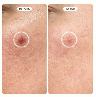 Before and after image showing improvement in skin texture with ZITSTICKA HYPERFADE™ dark spot patches.