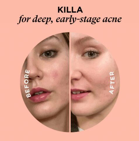 Before and after usingZITSTICKA KILLA microdart patches for deep, early-stage acne, showing clear skin improvement.