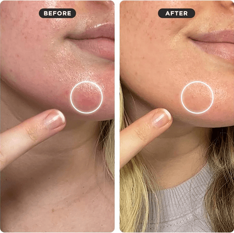 Before and after using ZITSTICKA comparison of skin with a focus on a blemish area.