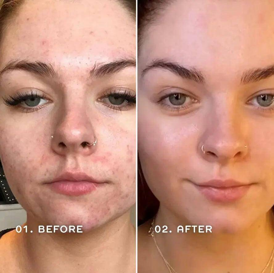 Before and after transformation showing skin improvement with REN Clean Skincare Ready Steady Glow Daily AHA Tonic.