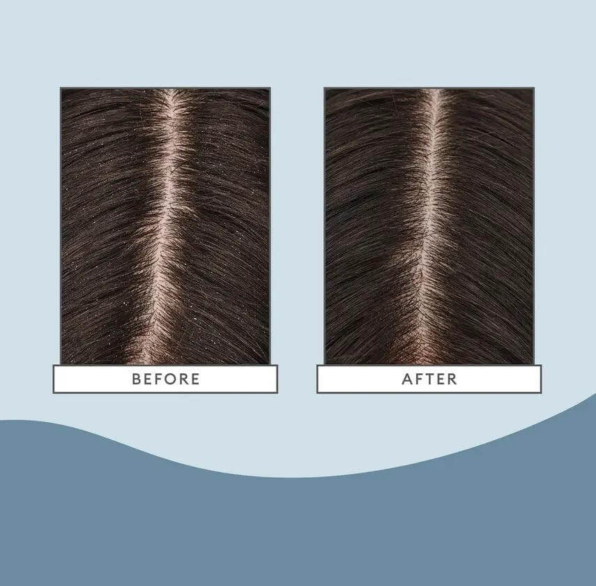 Before and after results of using Briogeo Scalp Revival Charcoal + Coconut Oil Micro-Exfoliating Shampoo on scalp.